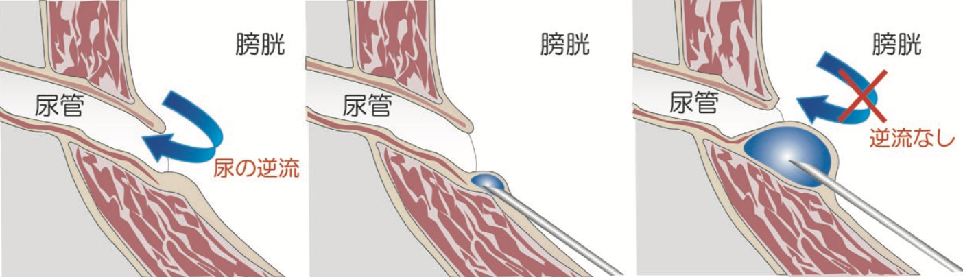 尿 管 内部 に は 逆流 防止 弁 が ある